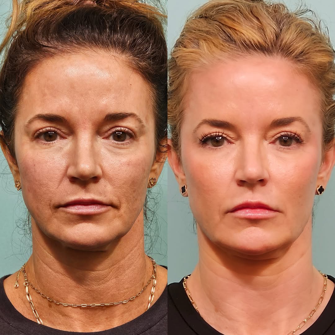 Instagram post by Dr. Shervin Naderi: It’s all in the combination ✨ For this patient, we focused on the face + neck, combining Morpheus8 and 3D Miracl to target texture, laxity, …