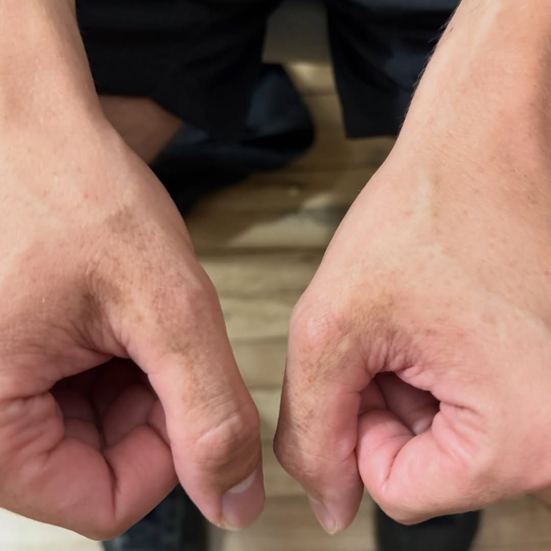 Instagram post by Dr. Sherwin Parikh: Double Jeopardy!!! What are these new tan brown spots that appeared symmetrically on this young man’s hands at the base of his thumbs ? Do y…