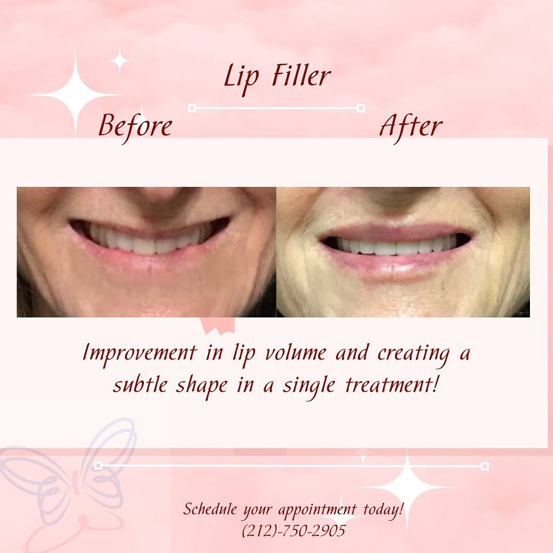 Instagram post by Dr. Sheryl D. Clark: ⭐️ Treatment: Lip Flip (Jeuveau & Restylane Kysse) This patient was over the moon with her lip flip results. She was treated with Jeuveau to…
