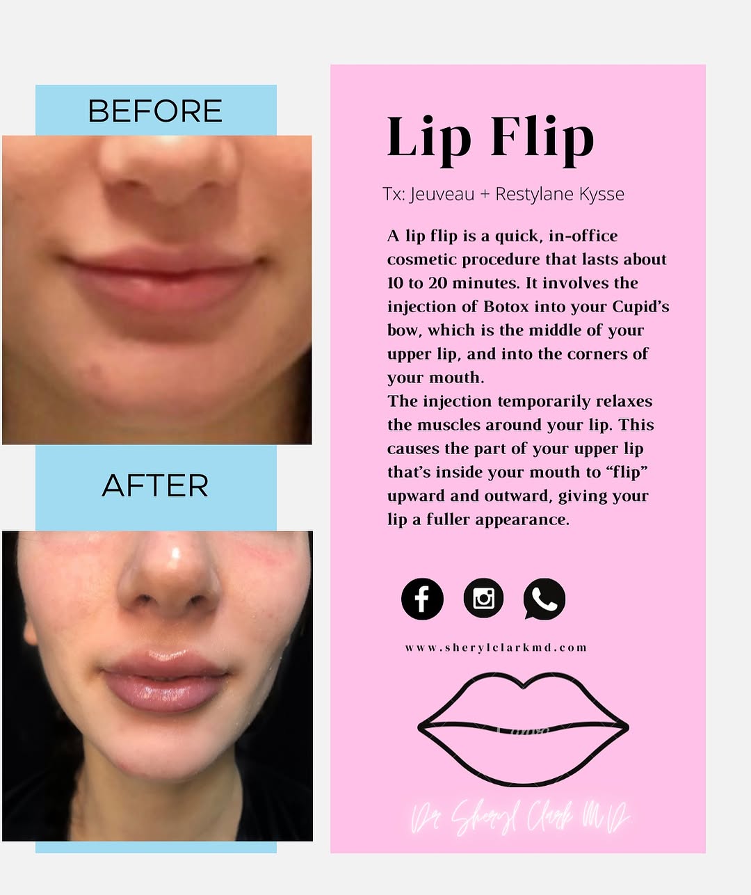 Instagram post by Dr. Sheryl D. Clark: Treatment: Lip flip + Lip filler ✨ Using Jeuveau & Restylane Kysse Do you have thin lips? Asymmetrical lips? An overhanging upper lip? Check…