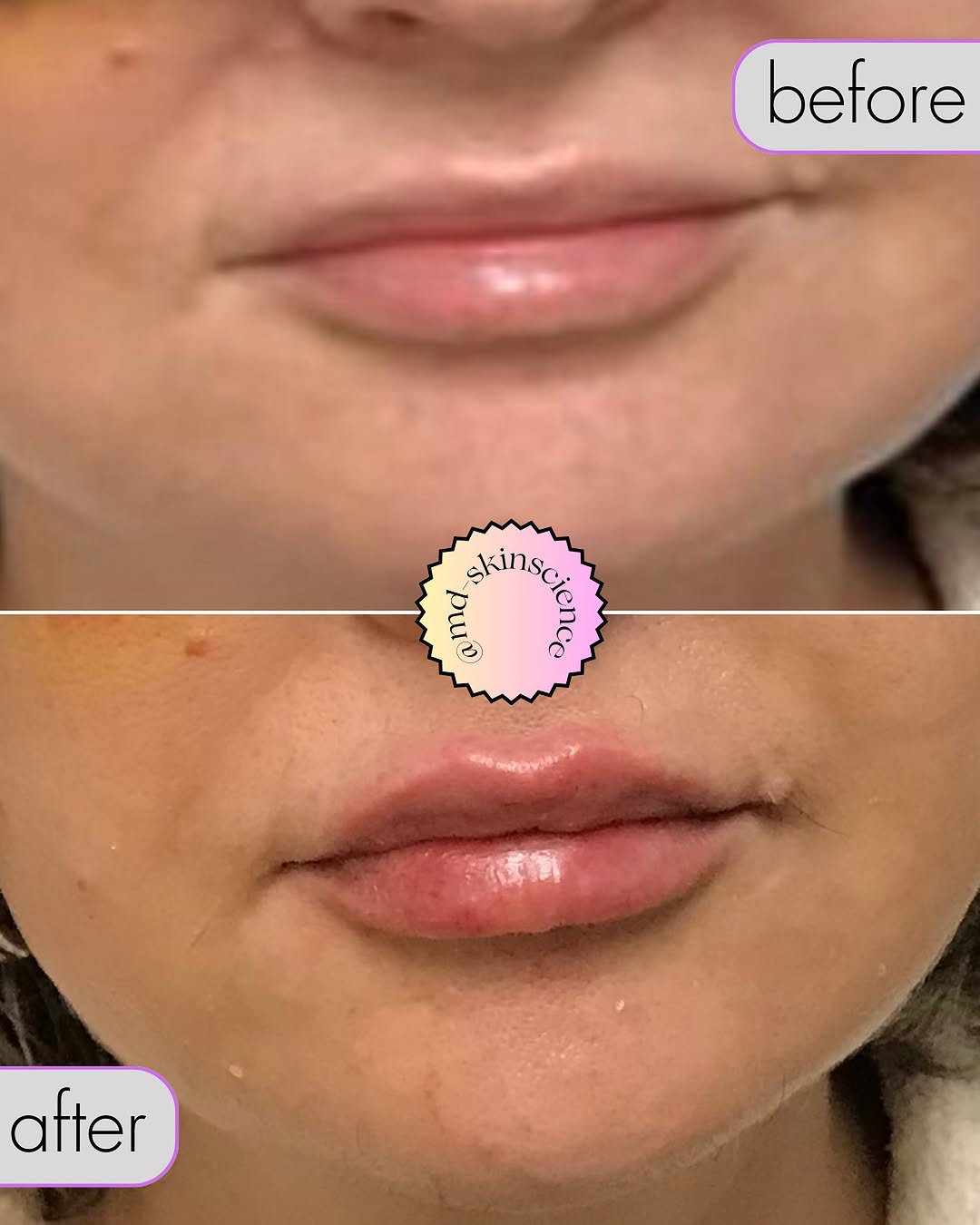 Instagram post by Dr. Sheryl D. Clark: ✨Looking to transform your smile? Experience a subtle enhancement that boosts your confidence and revitalizes your look with Restylane Kysse…