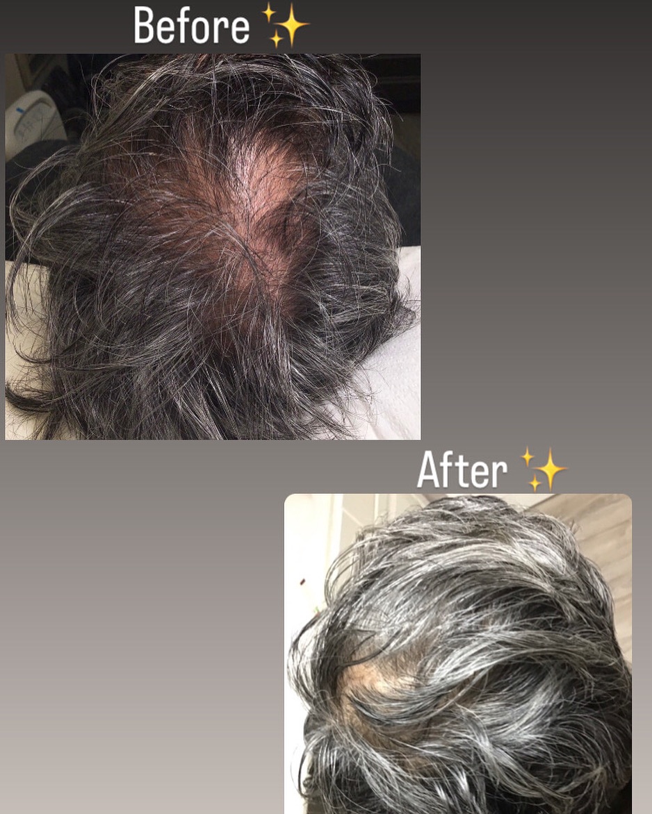 Instagram post by Dr. Sheryl D. Clark: ⭐️Treatment: Microneedling with PRP With PRP treatment, you can expect thicker, stronger hair with new growth from hair follicles that are s…