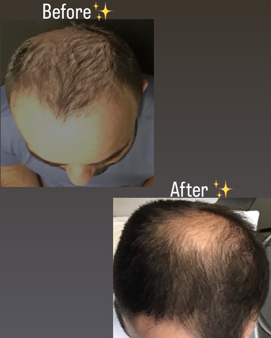 Instagram post by Dr. Sheryl D. Clark: 🌟 Treatment: Microneedling with PRP + Minoxidil By combining a course of minoxidil and microneedling with platelet- rich- plasma, you can e…