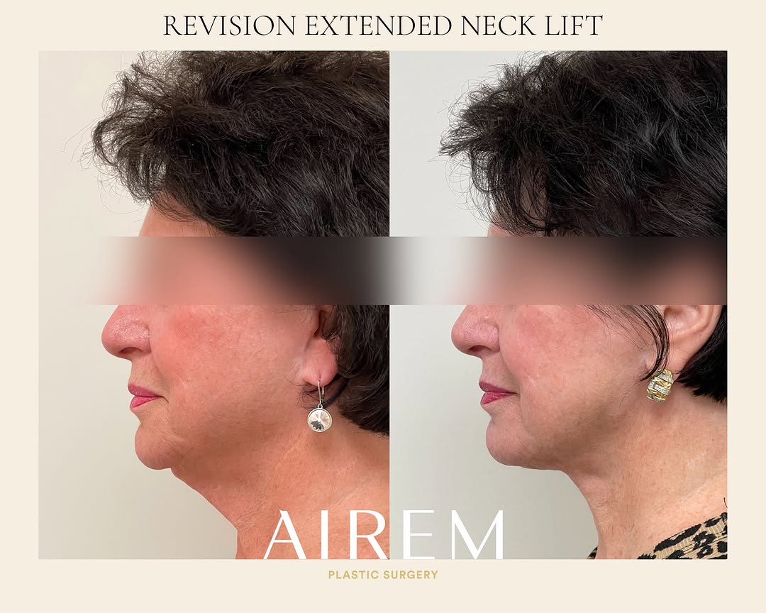 Instagram post by Dr. Shirley Hu: Shown here one year after her revision extended neck lift, my vibrant patient has a neck and jawline that defies her age. (She’s nearing 80!…