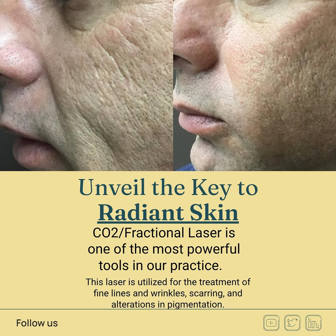 Instagram post by Dr. Shondra L. Smith: CO2/Fractional Laser covers many bases. It can be used for fine lines and wrinkles, scarring and pigment. These are the kinds of results we …