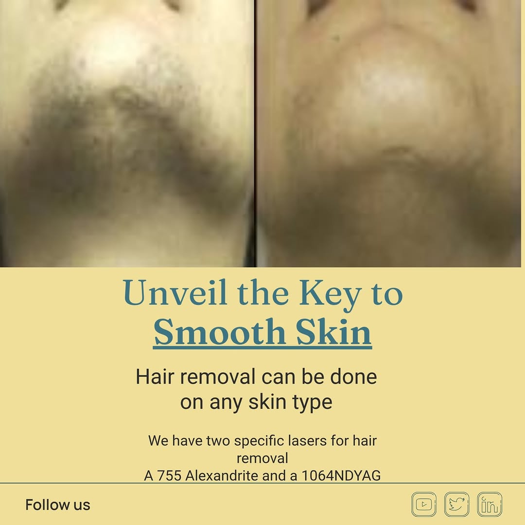 Instagram post by Dr. Shondra L. Smith: We have both a 755nm Alexandrite and a 1064nm NDYAG. This laser combination enables us to provide laser hair removal services to ALL skin ty…