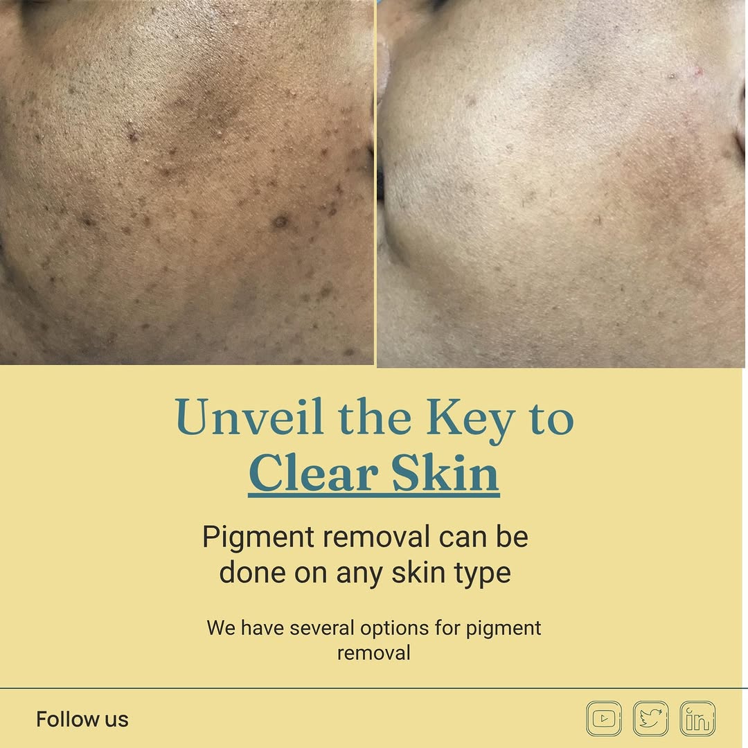 Instagram post by Dr. Shondra L. Smith: #ShondraSmithDermatology #pigmentremoval #vipeel #IPLforpigment #ShondraSmithDermatology #vipeel #iplforpigmentremoval