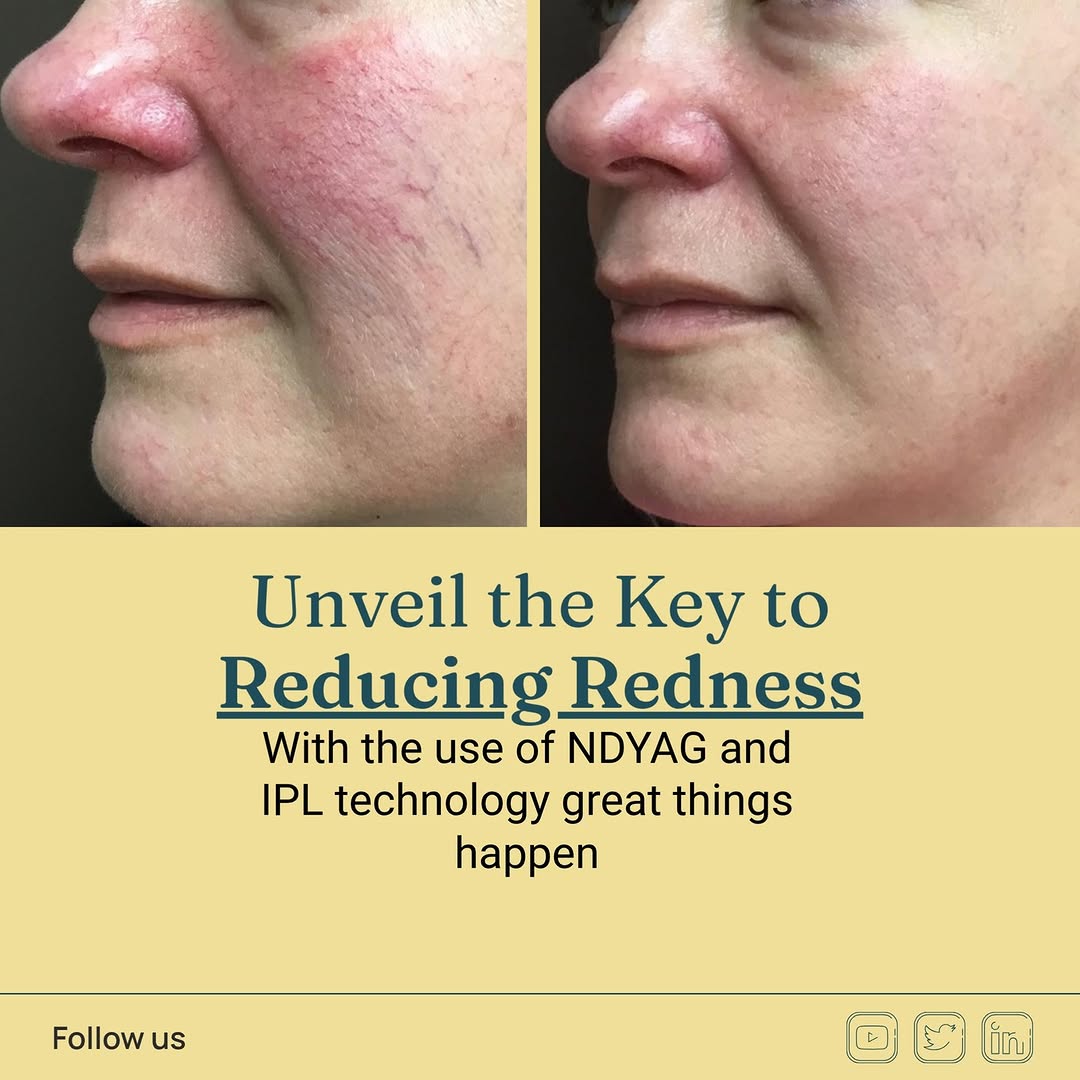 Instagram post by Dr. Shondra L. Smith: This patient was treated with a combination of a single treatment of IPL and 1064 NDYAG. We will have her back in 4 weeks to get rid of resi…