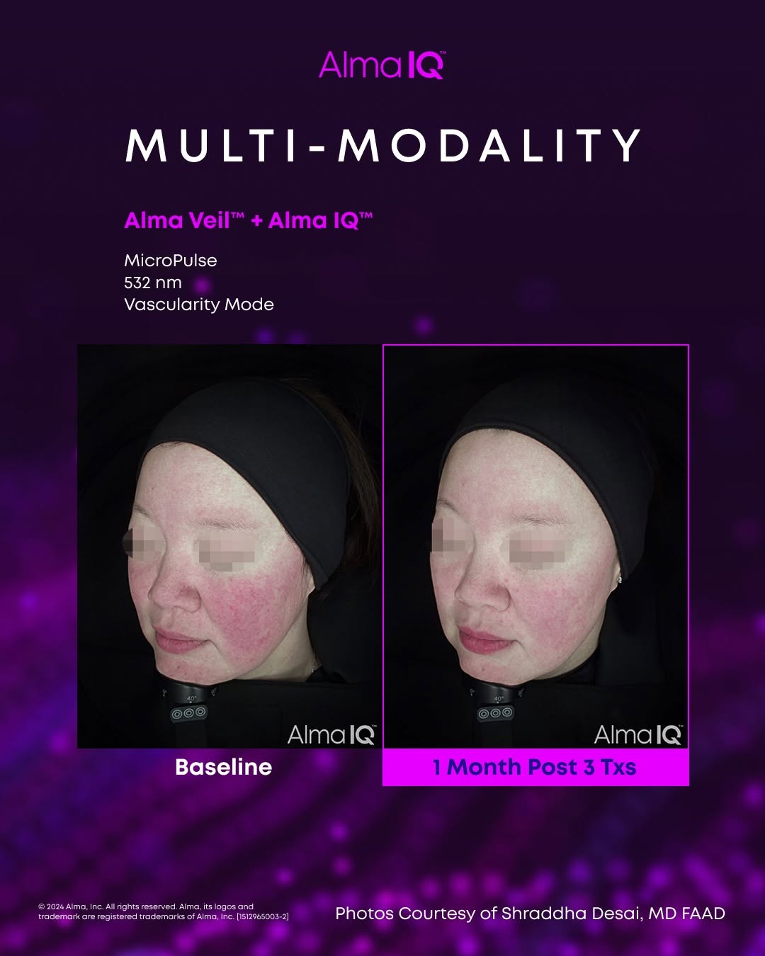Promotional image for AlmaIQ Multi-Modality treatment featuring Alma Veil and Alma IQ. Shows two side-by-side facial photos of a patient with skin visible under UV light; the left labeled 'Baseline' a