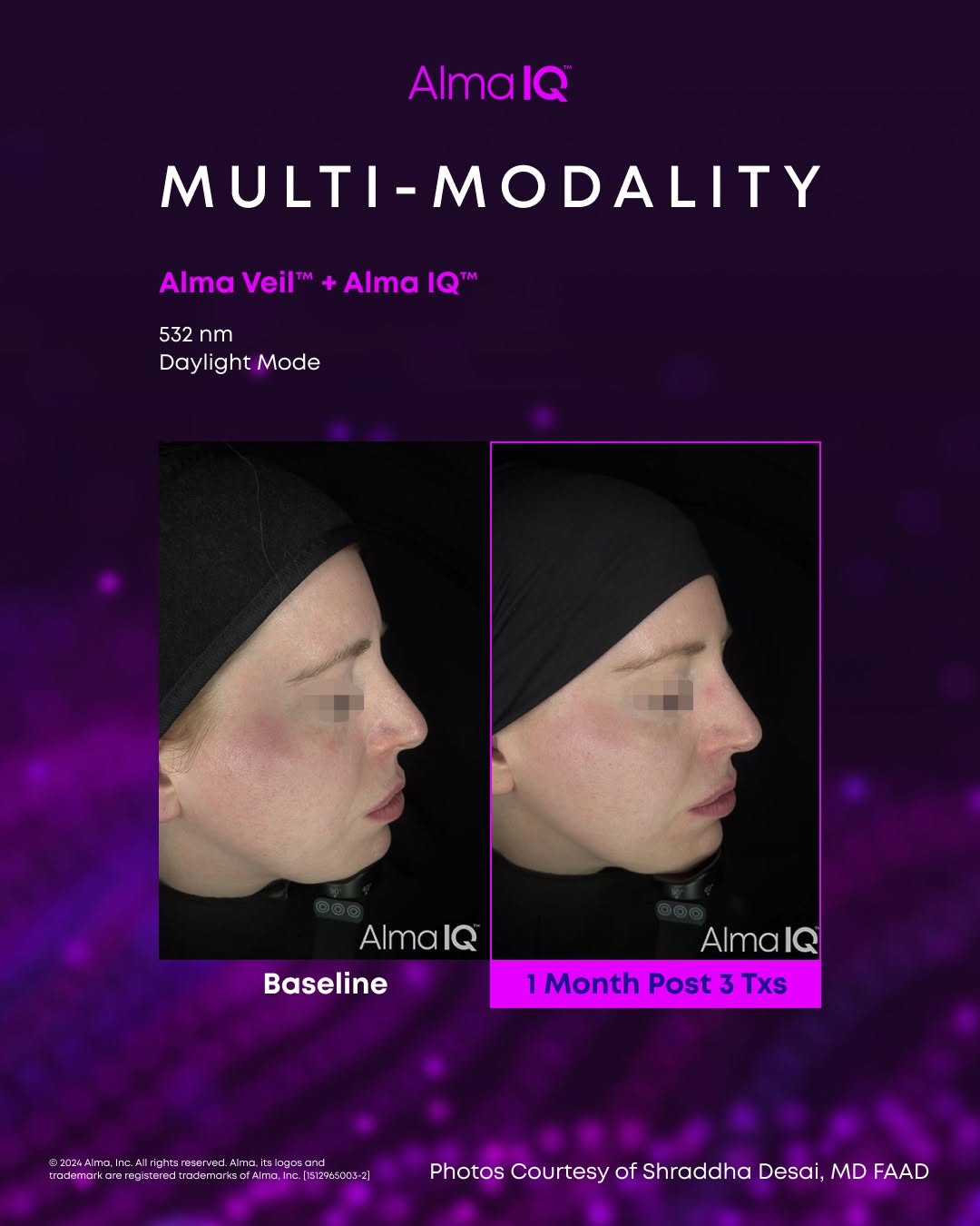 Advertisement for Alma Veil and Alma IQ showing before and after treatment effects on a person's profile under daylight mode, with improvements visible at 1 month post 3 treatments. The background is