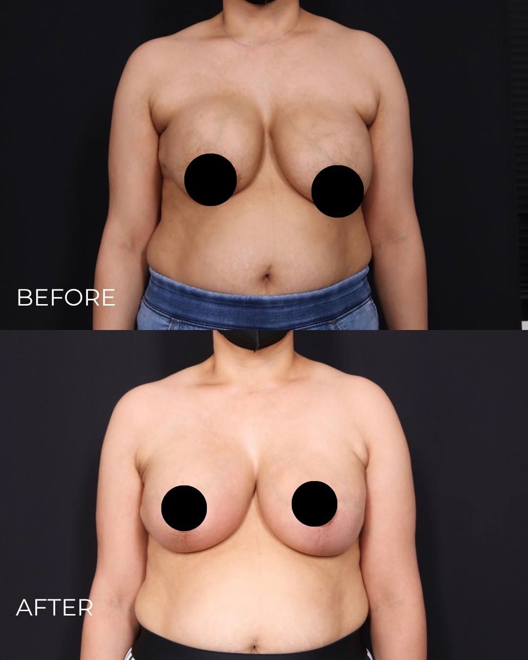 Instagram post by Dr. Shwetambara Parakh: What is capsular contracture? It happens when the scar tissue that naturally forms around a breast implant tightens, which can cause the bre…