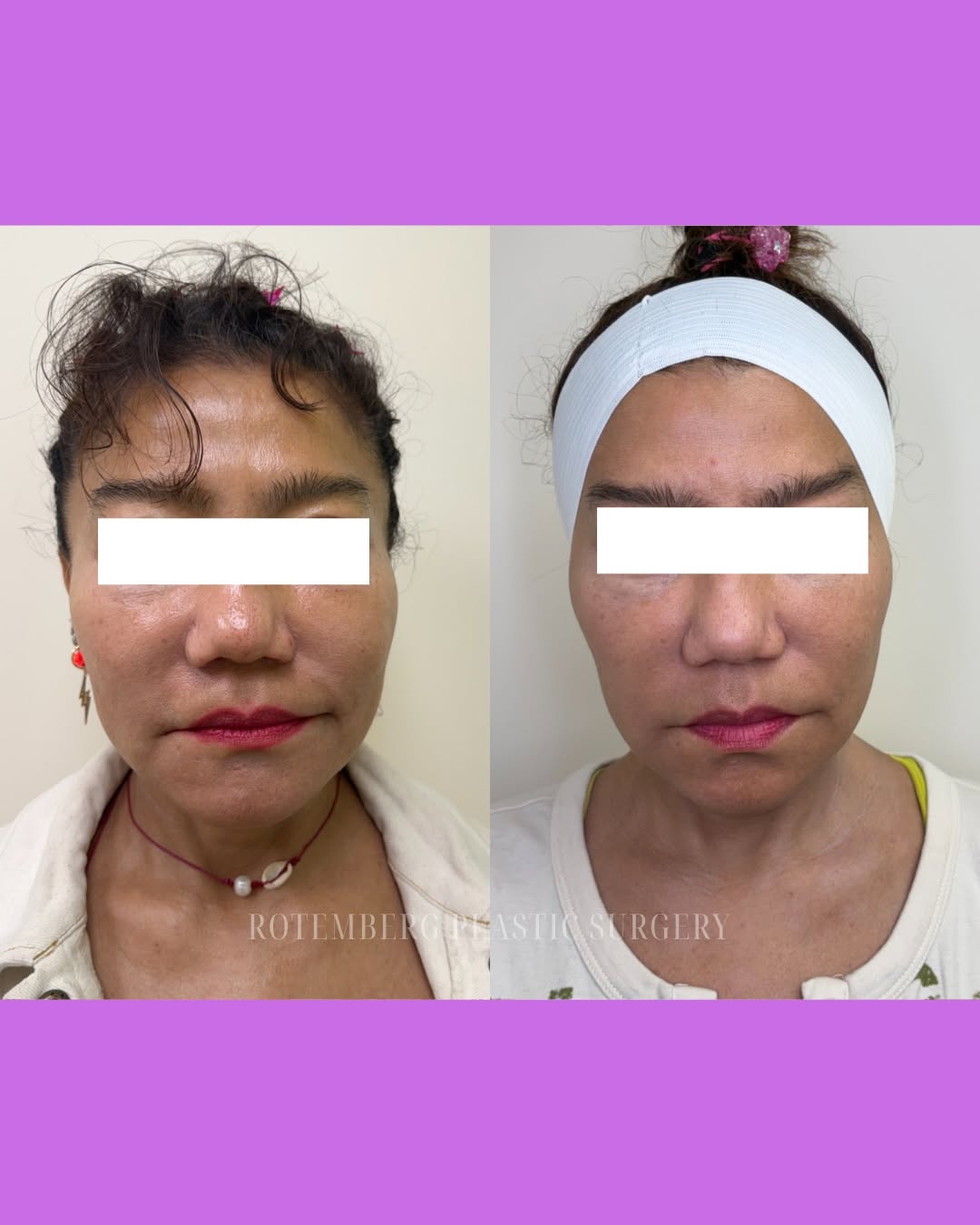 Instagram post by Dr. Silvia C. Rotemberg: XERF in action 🔥 Smoother-looking skin, improved firmness, and a beautifully sculpted appearance✨Call to schedule your consultation today⬇️…