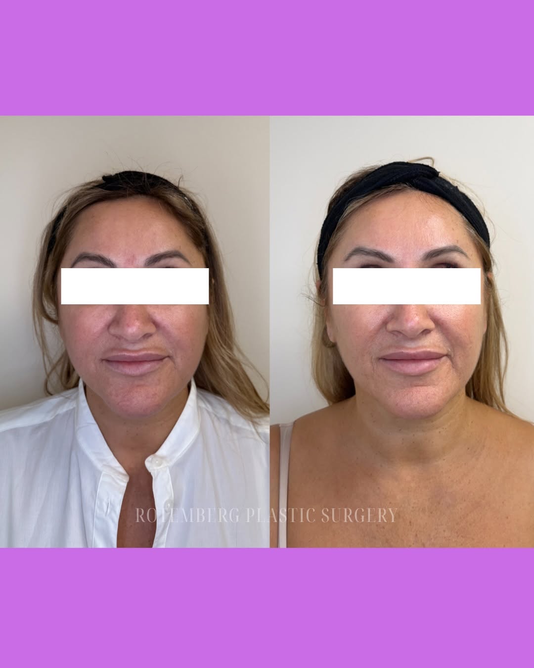 Instagram post by Dr. Silvia C. Rotemberg: ✨ Another XERF transformation ✨ Smoother-looking, firmer, more contoured skin without surgery💫 See the difference for yourself and discover…