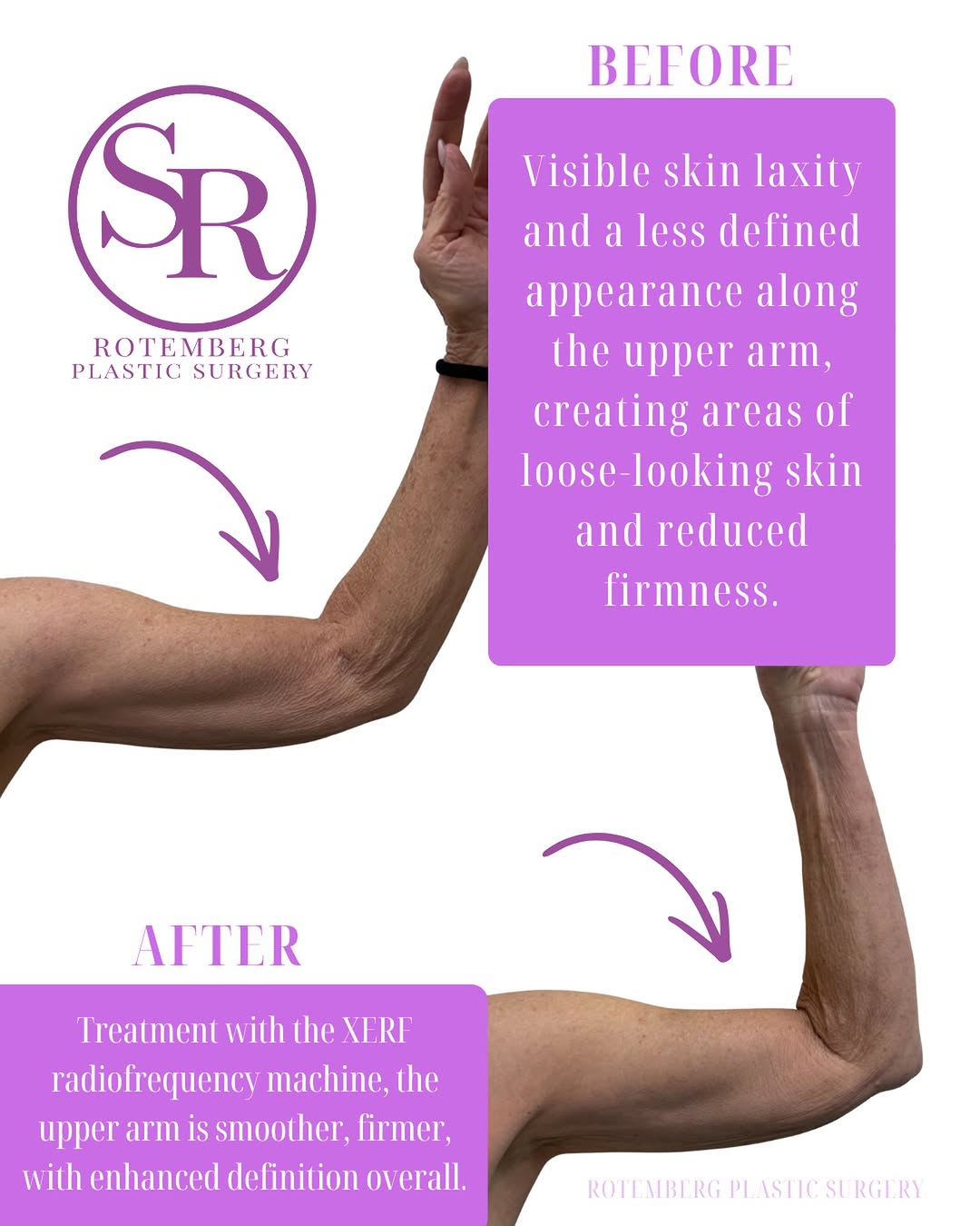 Instagram post by Dr. Silvia C. Rotemberg: Smoother. Firmer. More Defined. This XERF before & after showcases the visible improvement in the appearance of skin laxity along the upper …