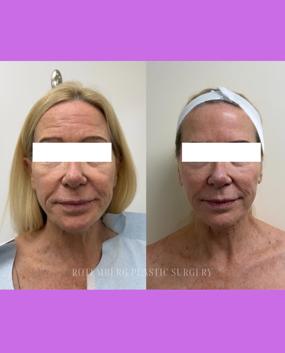 Instagram post by Dr. Silvia C. Rotemberg: A little lift, a smoother look, a refreshed you✨ This XERF™ before & after highlights visible improvements in skin firmness, contour, and te…