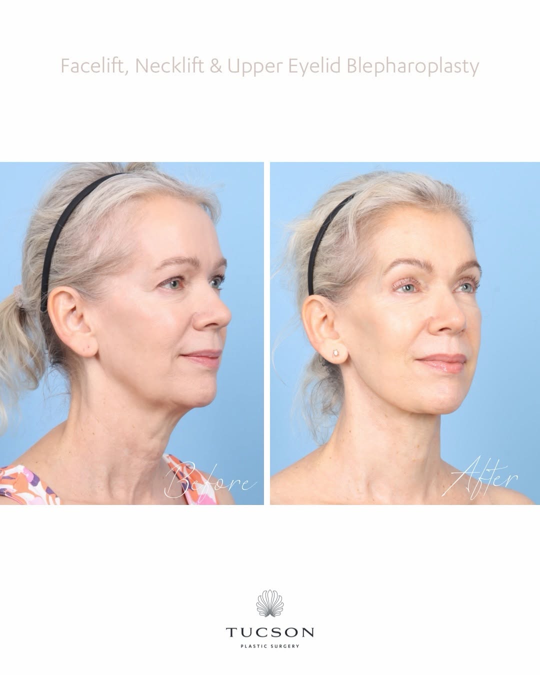 Instagram post by Dr. Silvia Kurtovic: A refreshed look, thoughtfully restored. ✨ This incredible transformation features a facelift, neck lift, and upper blepharoplasty, designed…