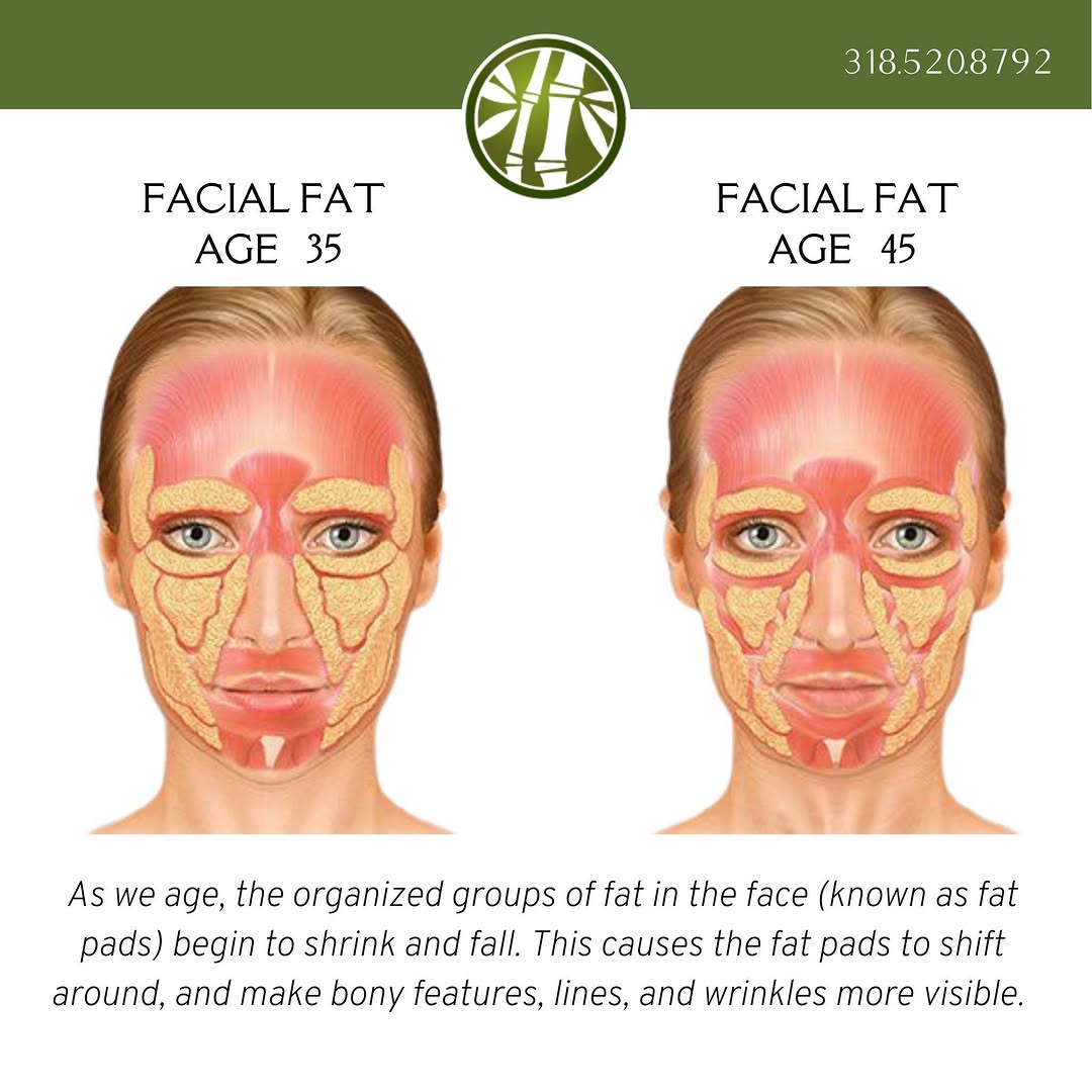 Instagram post by Dr. Simeon Wall, Sr: At Jade MediSpa, we have treatments and products that can replace the volume loss in your face and restore your youthfulness. For a free con…
