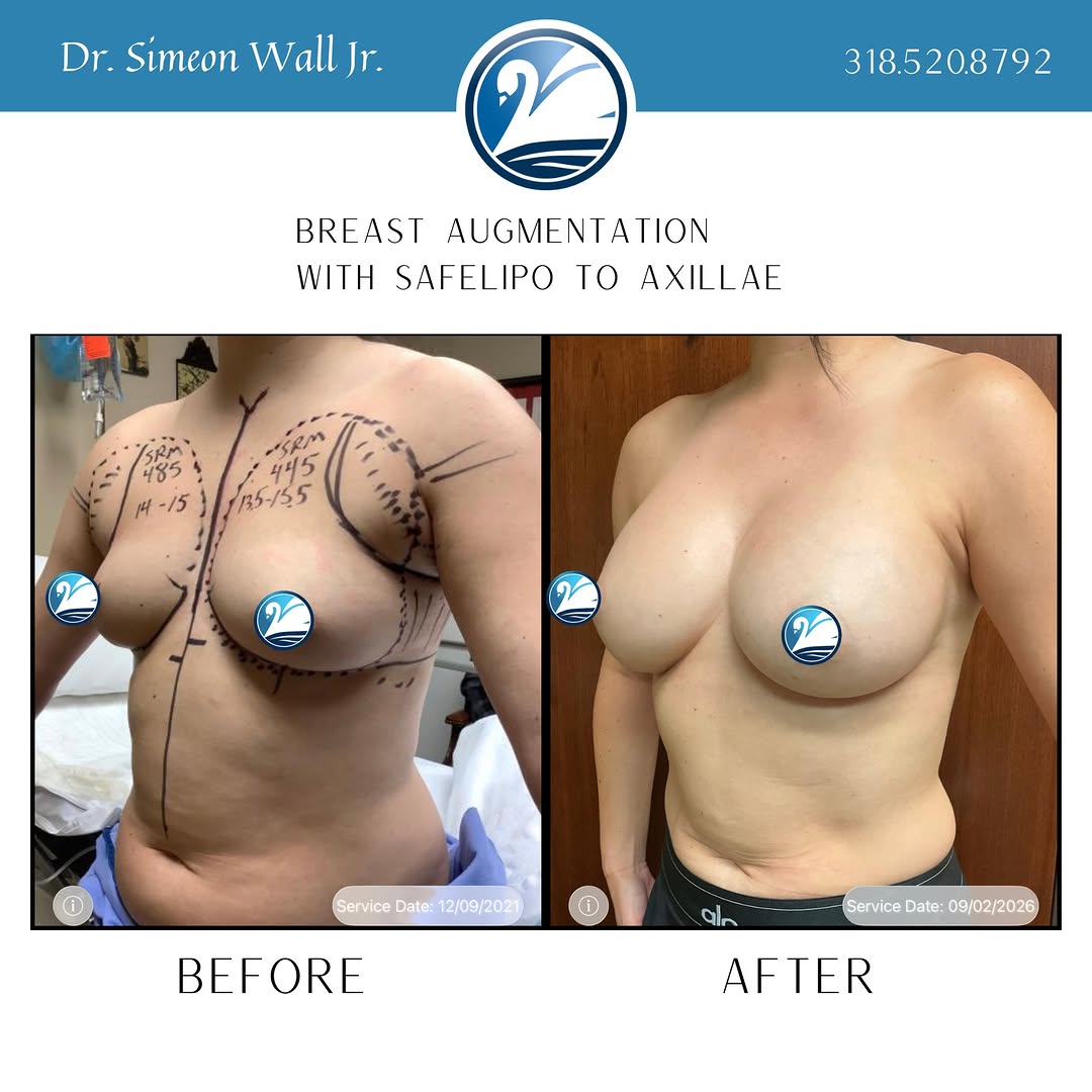 Instagram post by Dr. Simeon Wall, Sr: Straight off the surgeon's iPad! 5 years post-op from a breast augmentation with SAFELipo to the armpit area for a smooth silhouette. Dr. Wa…
