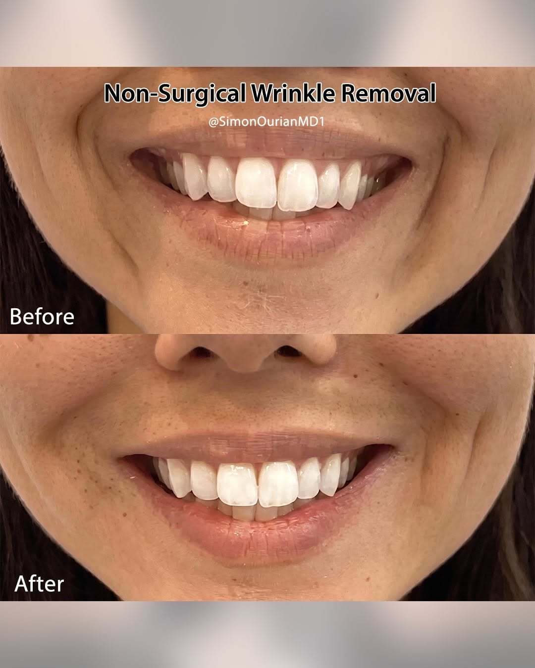 Instagram post by Dr. Simon Ourian: Dr. Simon Ourian reviews the latest insights on non-surgical wrinkle removal to help you understand what may be right for you. If you’re con…