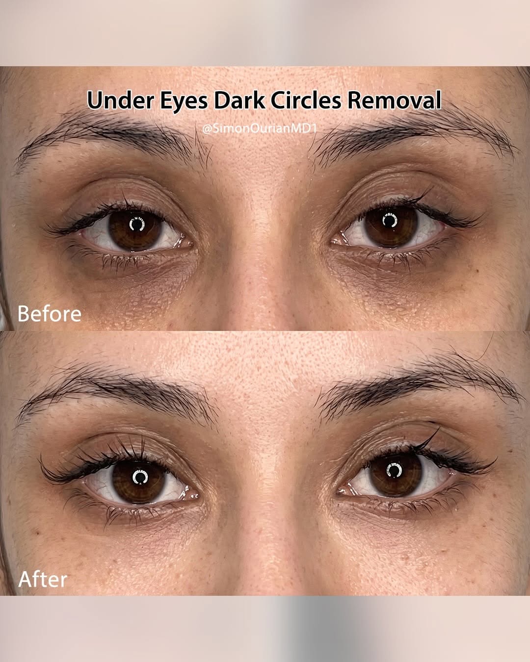 Instagram post by Dr. Simon Ourian: Dr. Simon Ourian reviews the latest insights on under-eye dark circle treatment to help you understand what may be right for you. If you’re …
