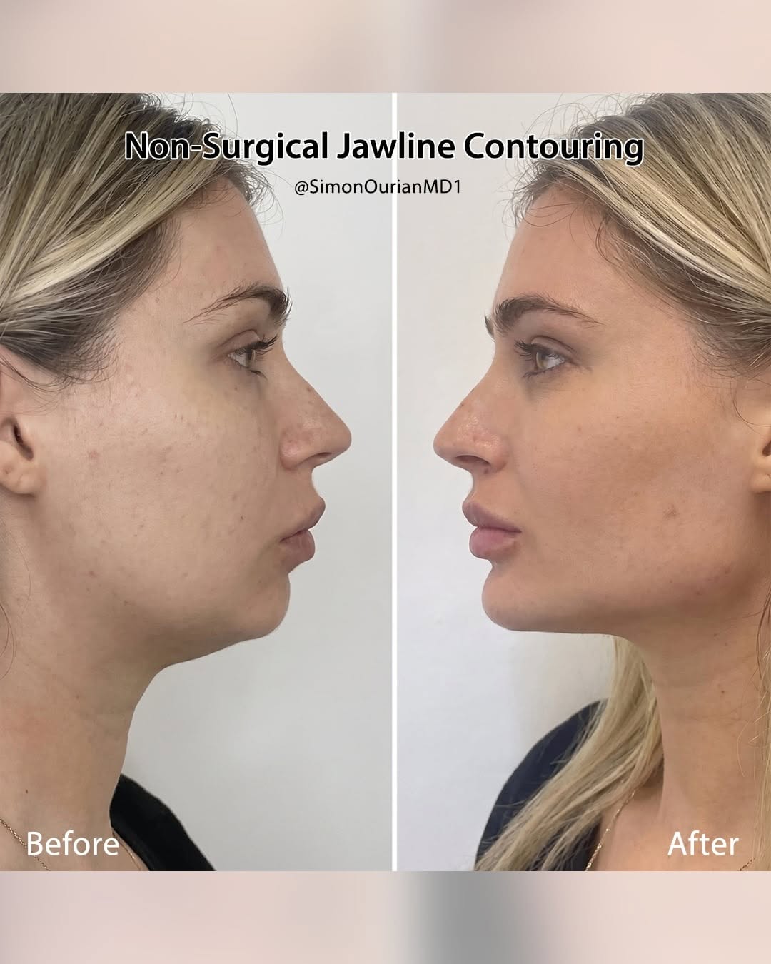 Instagram post by Dr. Simon Ourian: Dr. Simon Ourian reviews the latest insights on non-surgical jawline contouring to help you understand what may be right for you. If you’re …