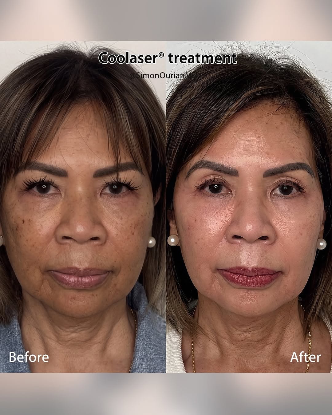 Instagram post by Dr. Simon Ourian: Dr. Simon Ourian reviews the latest insights on Coolaser® treatment to help you understand what may be right for you. If you’re considering …