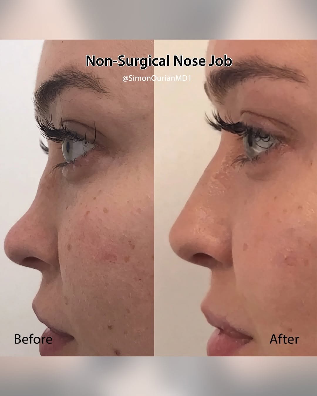 Instagram post by Dr. Simon Ourian: Dr. Simon Ourian reviews the latest insights on nose reshaping options to help you understand what may be right for you. If you’re consideri…