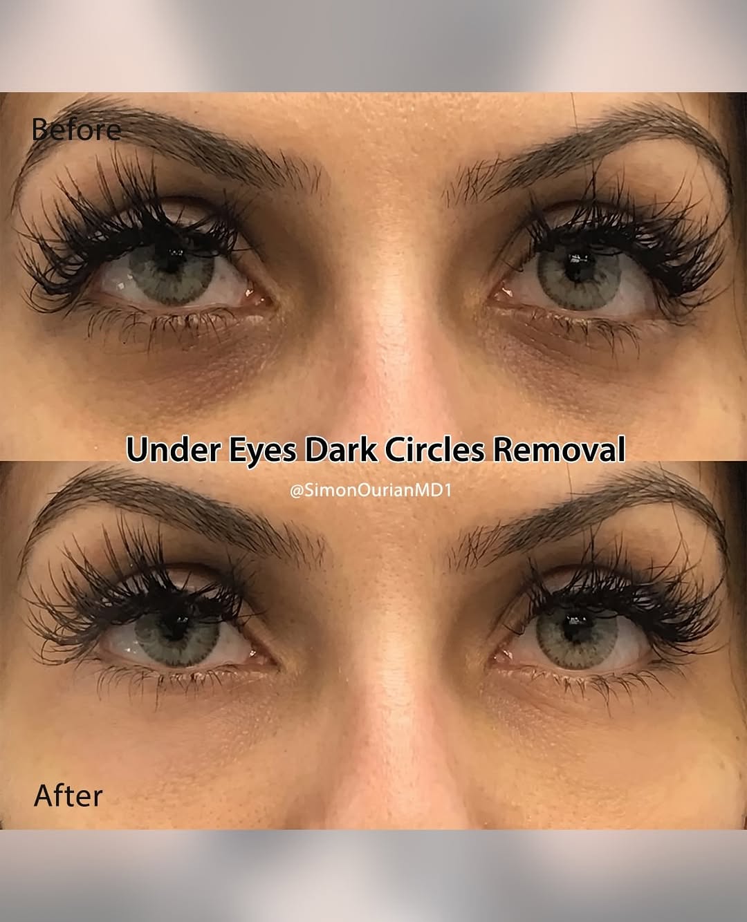 Instagram post by Dr. Simon Ourian: Dr. Simon Ourian reviews the latest insights on under-eye dark circle treatment to help you understand what may be right for you. If you’re …