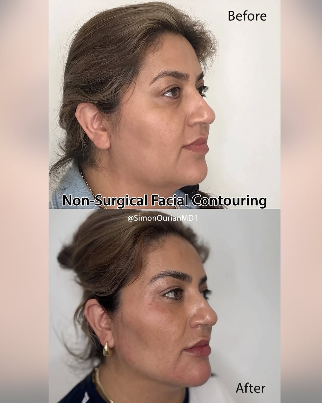 Instagram post by Dr. Simon Ourian: Dr. Simon Ourian reviews the latest insights on facial contouring options to help you understand what may be right for you. If you’re consid…