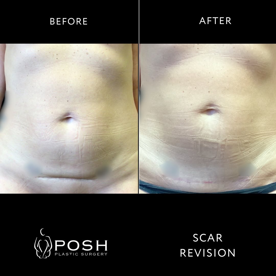 Instagram post by Dr. Sofia K. Kirk: Say goodbye to unwanted scars with our expert scar revision procedure at Posh Plastic Surgery. Dr. Kirk uses advanced techniques to improve …