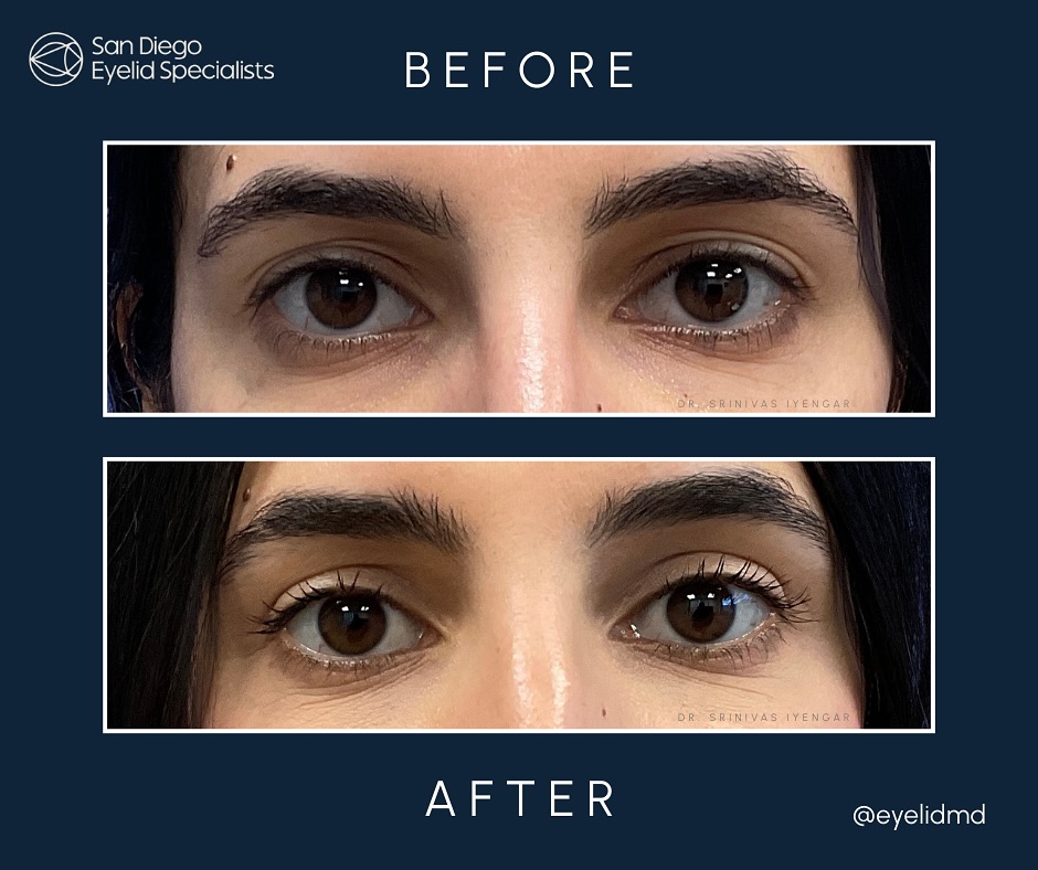Instagram post by Dr. Srinivas S. Iyengar: A beautifully subtle transformation 🌸 This patient came down from LA to see us ahead of her wedding. We performed an upper eyelid blepharop…