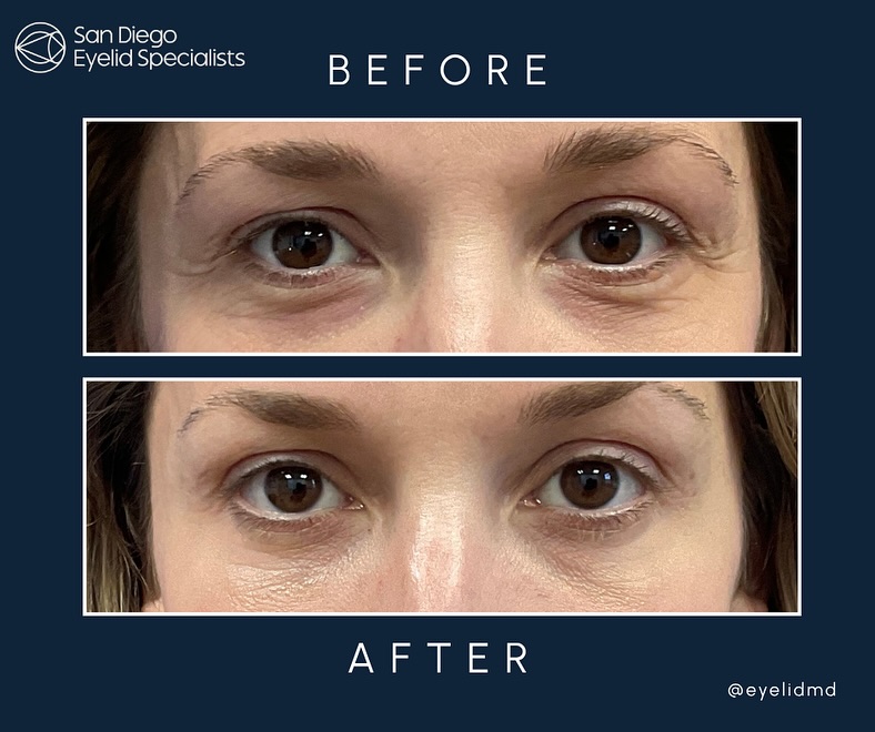 Instagram post by Dr. Srinivas S. Iyengar: A soft transformation with lasting impact 🌸 This patient came to see Dr. Iyengar for lower eyelid rejuvenation. Through a customized, scarl…