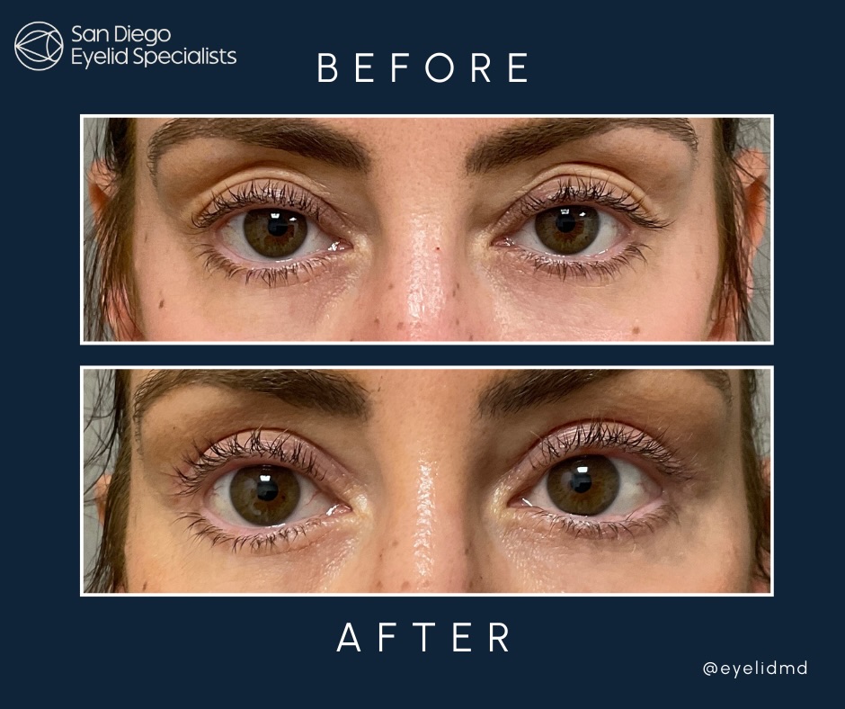 Instagram post by Dr. Srinivas S. Iyengar: A brighter, natural look, without the operating room. This lovely patient was referred to Dr. Iyengar by friends and physicians. She underwe…