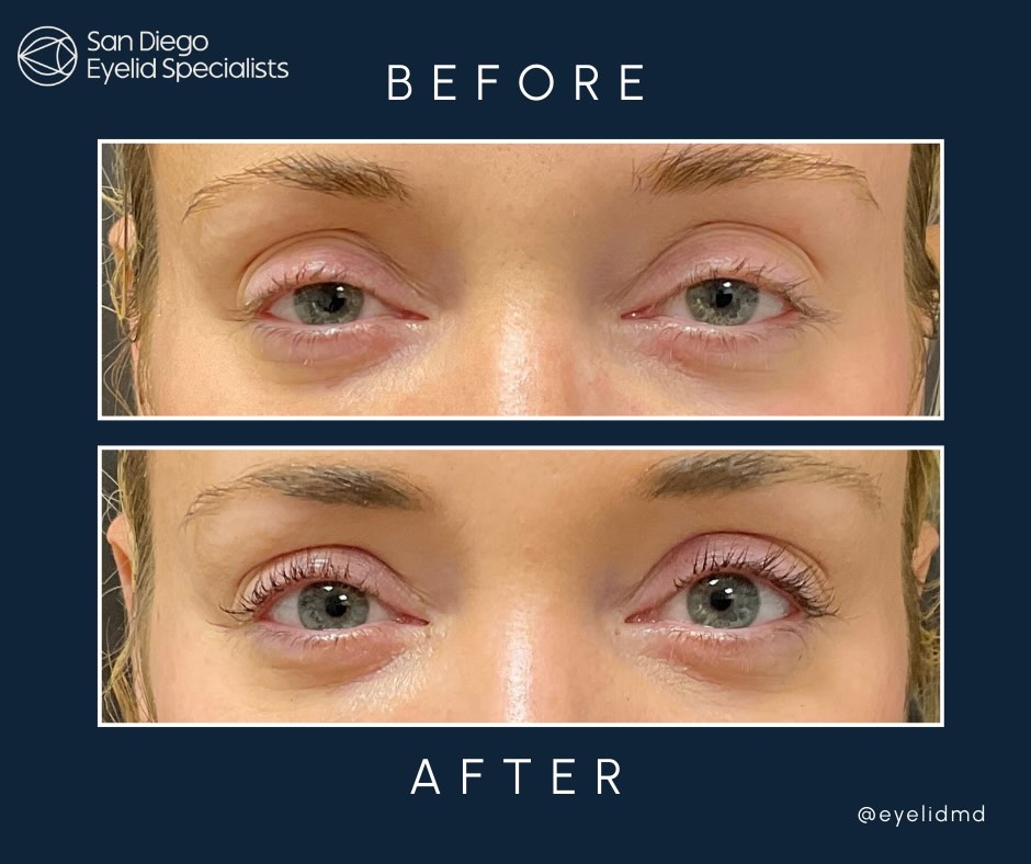Instagram post by Dr. Srinivas S. Iyengar: Where beautiful aesthetics meet perfect function. ⚡️ This patient underwent scarless ptosis surgery with Dr. Iyengar. Her result reveals bri…