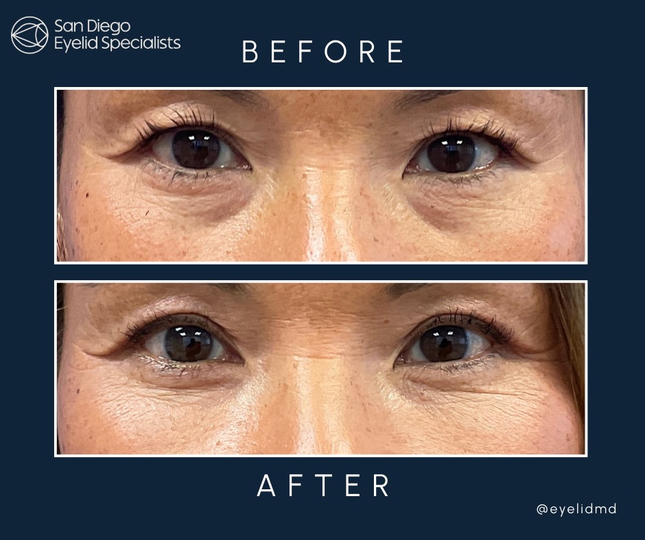 Instagram post by Dr. Srinivas S. Iyengar: Refined, not overdone 👁️✨ Bespoke scarless lower eyelid blepharoplasty with fat repositioning — smoothing under-eye hollows while preservin…