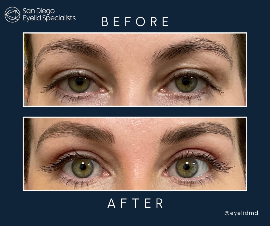 Instagram post by Dr. Srinivas S. Iyengar: Glamorous doesn’t have to mean dramatic ✨ This wonderful patient had an upper eyelid blepharoplasty — designed to open the eyes while keepin…