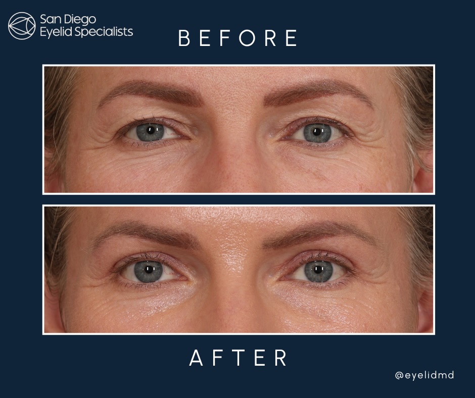 Instagram post by Dr. Srinivas S. Iyengar: Subtle changes, refreshed confidence ✨ This nice patient had bespoke upper eyelid surgery removing heaviness to restore a brighter, smooth a…