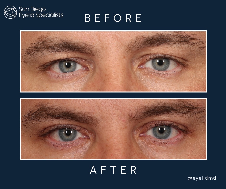 Instagram post by Dr. Srinivas S. Iyengar: This nice male executive wanted a nice subtle improvement in his upper eyelids. He underwent customized eyelid surgery in the office under l…