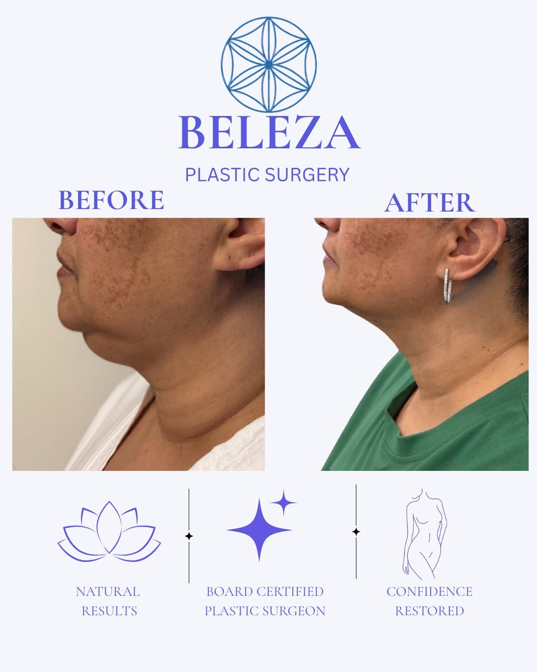 Instagram post by Dr. Staci Hix-Hernandez: A little contour can make a BIG difference. ✨ This chin lipo transformation shows what targeted fat removal can do to create a more defined …