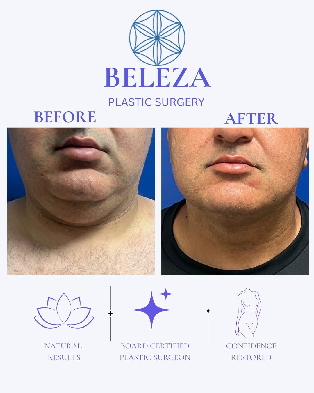Instagram post by Dr. Staci Hix-Hernandez: ✨ CHIN LIPO SPECIAL! ✨ Ready for a more defined, sculpted jawline? Check out this Chin Lipo before & after! 😍 🔥 LIMITED-TIME SURGERY SPECI…