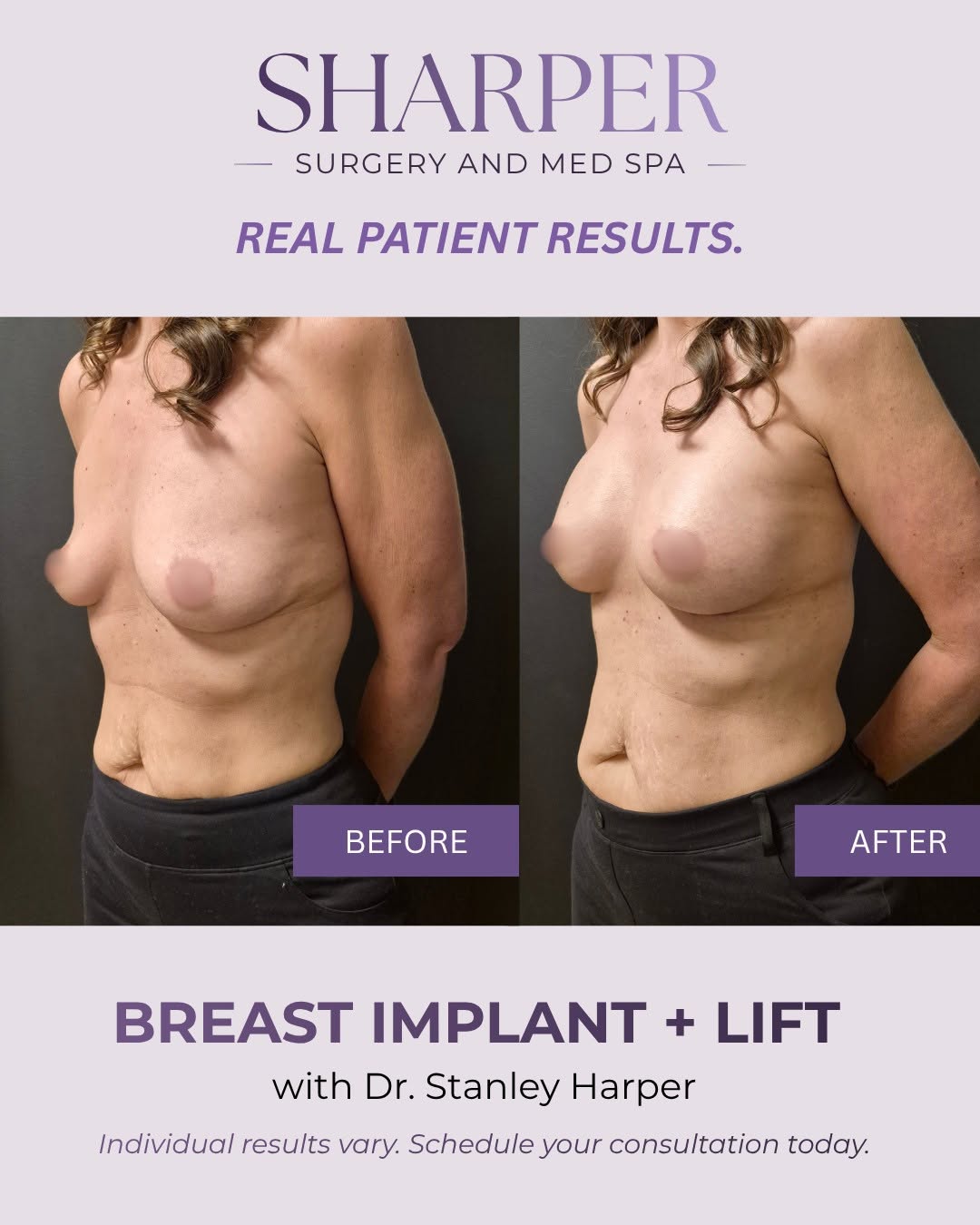 Instagram post by Dr. Stanley Harper: The difference is in the details. 👏 This before-and-after shows what’s possible when a breast lift and breast implants are thoughtfully com…