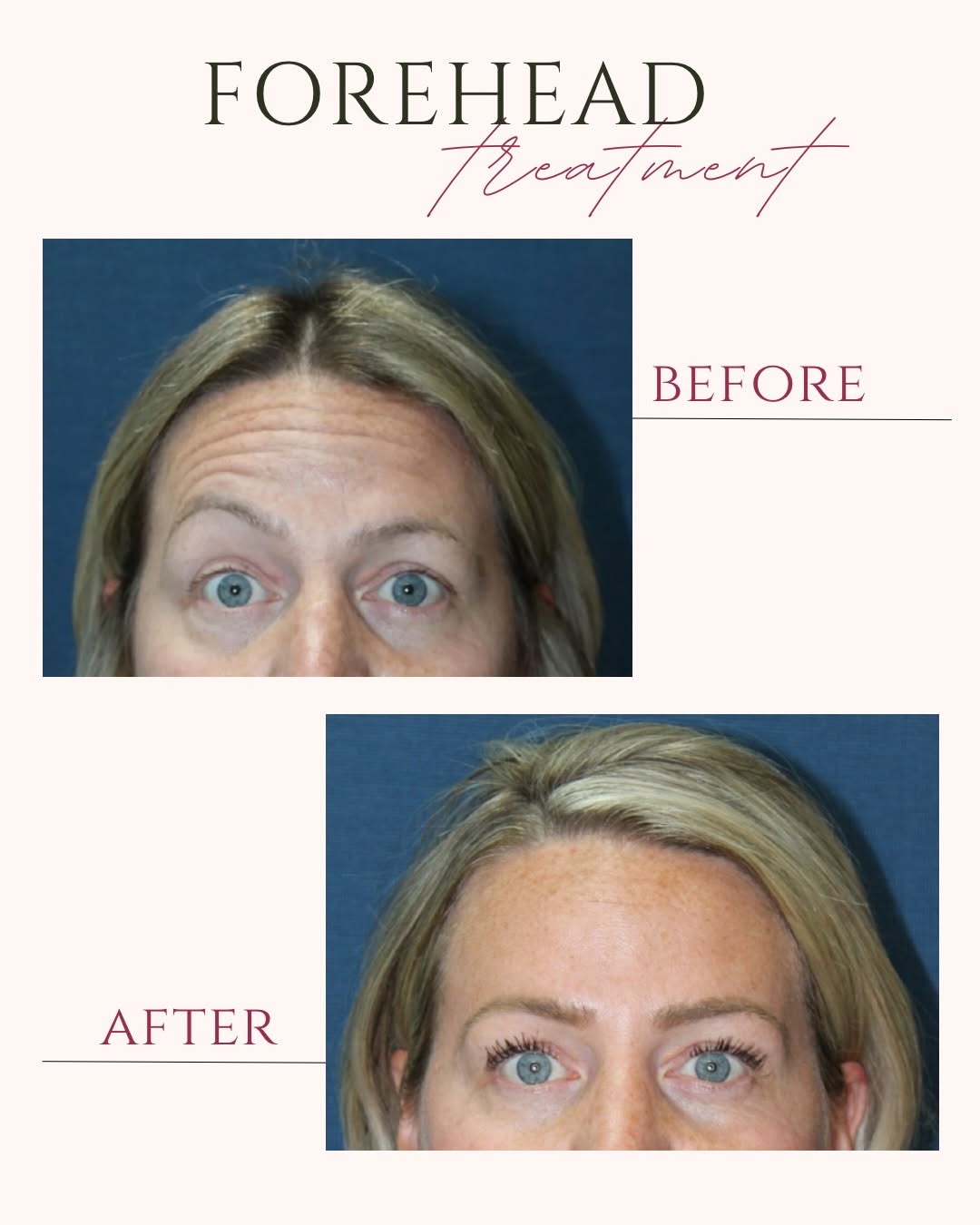 Instagram post by Dr. Stanley W. Jacobs: From expressive lines to a smoother, more refreshed forehead ✨ Botox to the glabella + frontalis for a soft, natural, balanced result while …