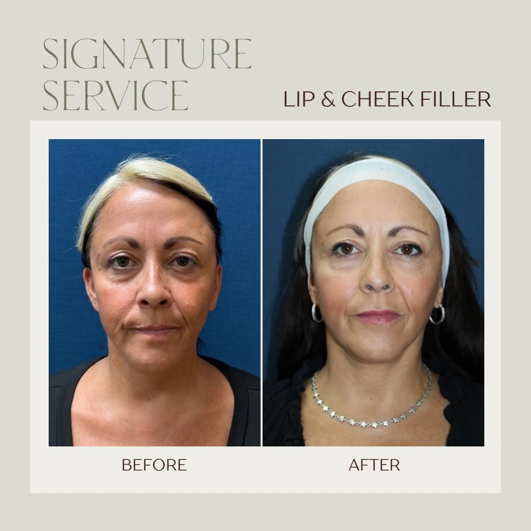 Instagram post by Dr. Stanley W. Jacobs: Cheek + lip filler for that ✨fresh, lifted, hydrated✨ glow. Looking to glow? Let’s enhance what you already have while keeping it natural, b…