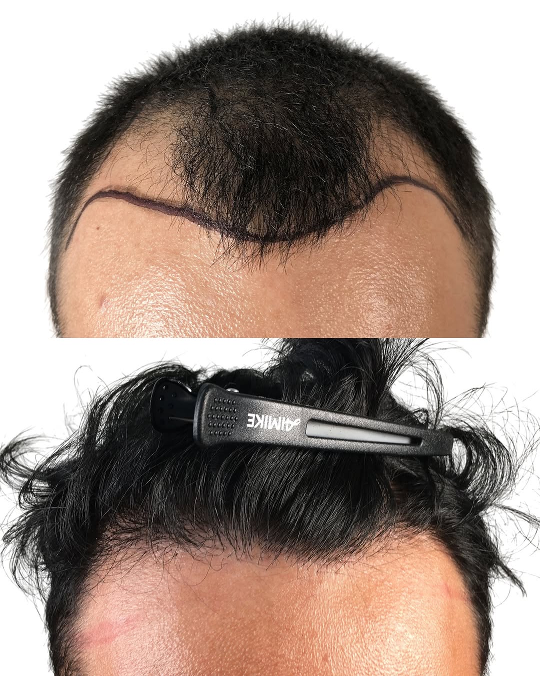 Instagram post by Dr. Stefan Thiele: A natural-looking hairline is about more than just filling in areas where hair has been lost. For this patient, we focused on restoring the …