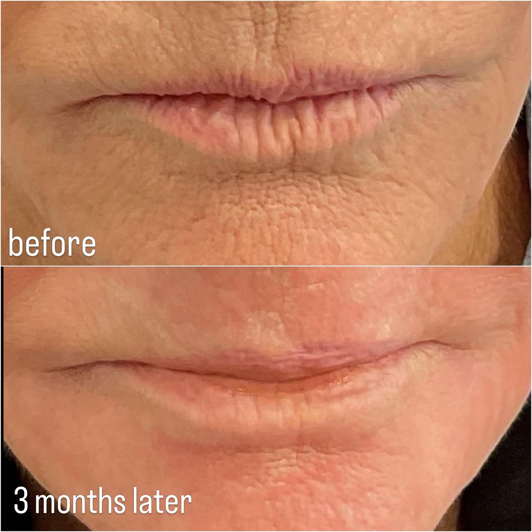 Instagram post by Dr. Stefani Kappel: I am always impressed with this laser. This patient had one treatment with the Contour TRL laser. Her skin texture was improved and her skin…