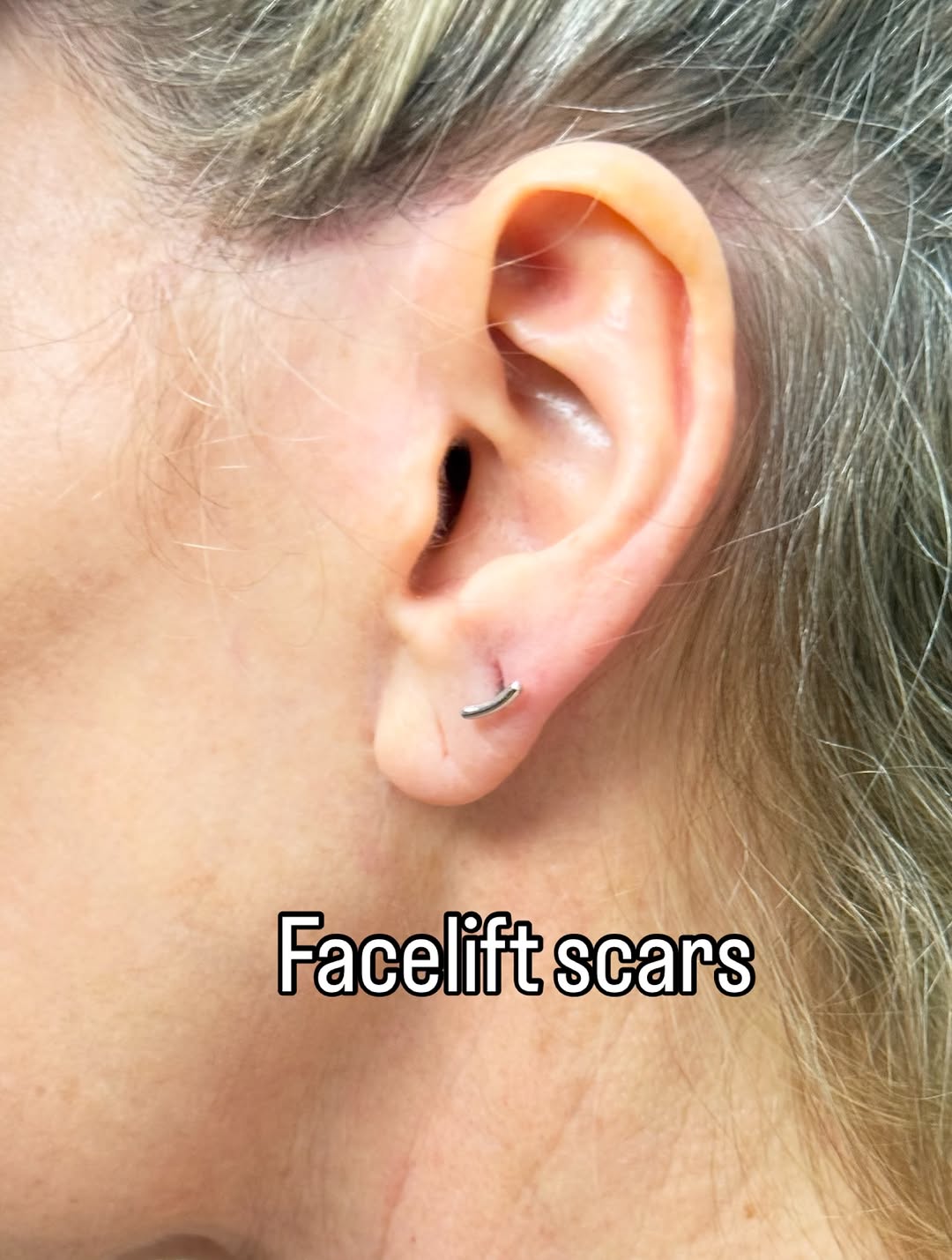 Instagram post by Dr. Stella Desyatnikova: This is what healed scars from a facelift are supposed to look like. I take my time so it could look like this.