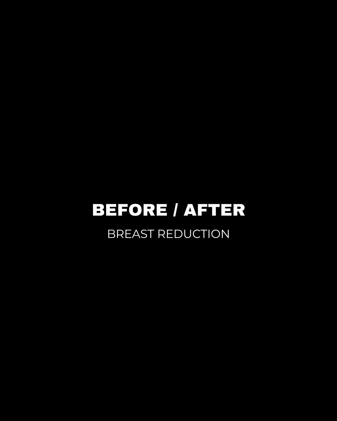 Instagram post by Dr. Stephan Baker: Procedure: Breast Reduction Age: 64 Tissue removed: L 461 g and R 416 g After photos taken 4 months after surgery A beautiful example of how…
