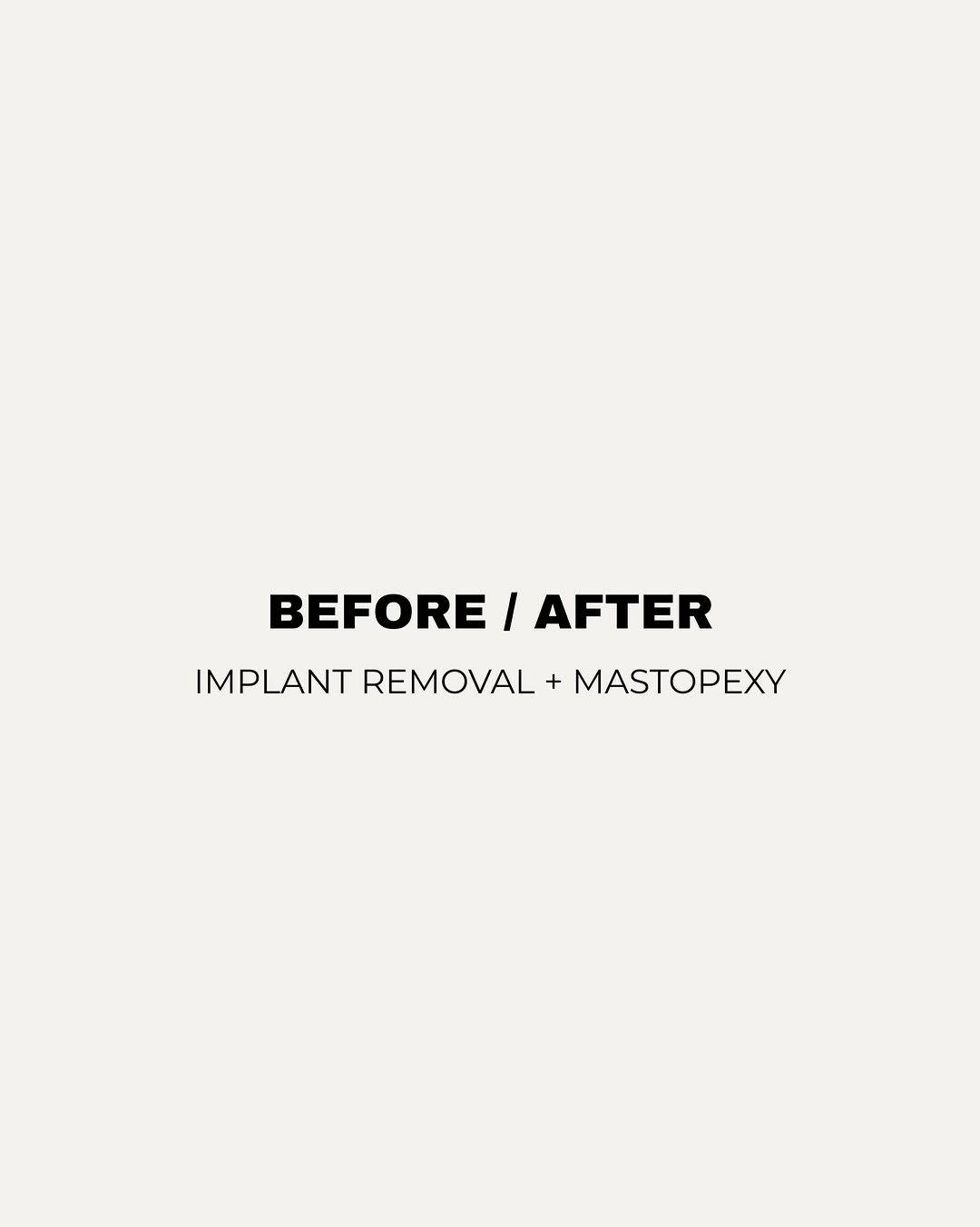 Instagram post by Dr. Stephan Baker: Procedure: Breast Implant Removal and Mastopexy Age: 57 After photos taken 2 months after surgery Removing breast implants is about more tha…