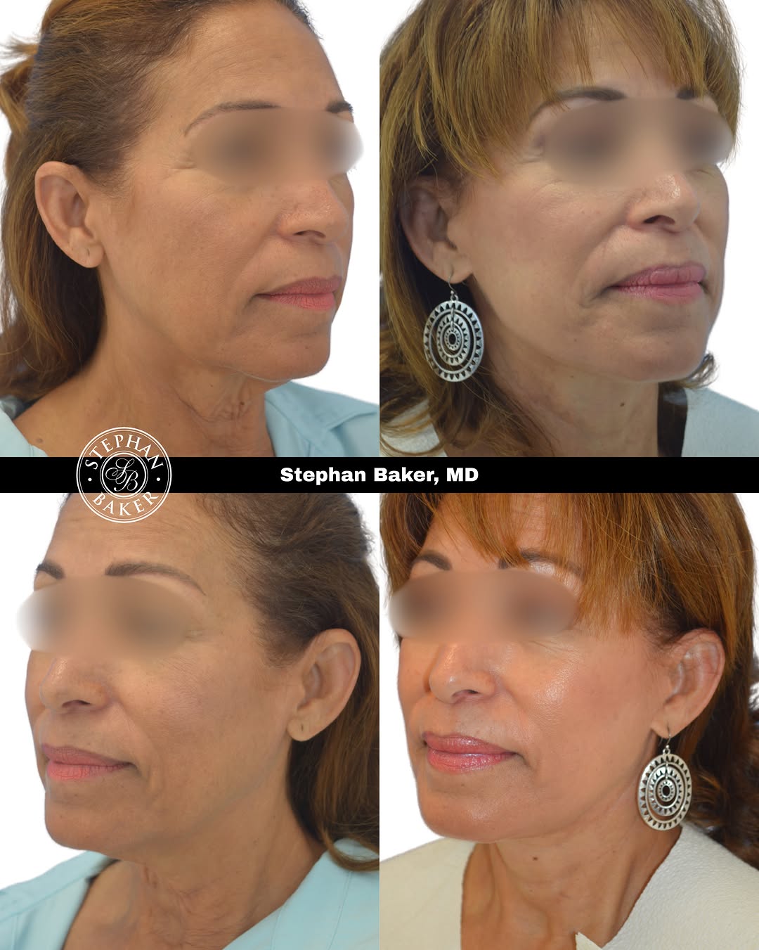 Instagram post by Dr. Stephan Baker: Procedure: Face and Neck Lift Age: 67 After photos taken 8 months after surgery A face and neck lift is more than removing excess skin. With…