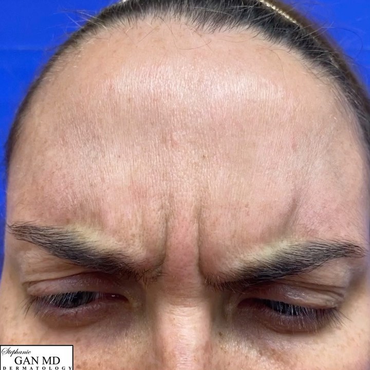 Instagram post by Dr. Stephanie Gan: Happy Botox Cosmetics Day! 🥳⁣ ⁣ Did you know that Botox can help fight depression? ⁣ ⁣ In 2014, Finzi and Rosenthal published the largest s…